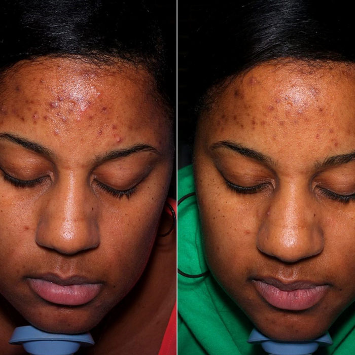 BioAcne Facial - For Acneic Skin