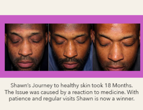 Hyperpigmentation Recovery